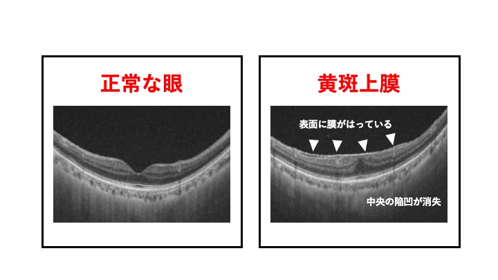 黄斑上膜 いつ手術する？ | かなざわ土屋眼科