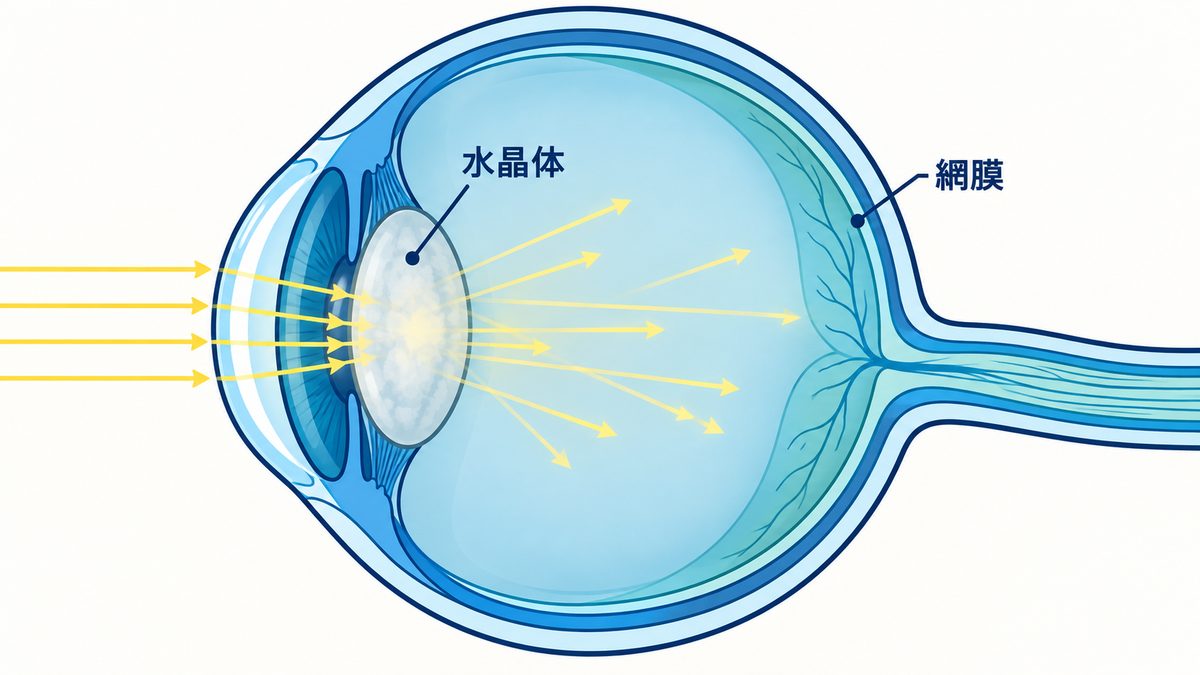 目の断面図。目の前方にある水晶体が白く濁っている様子