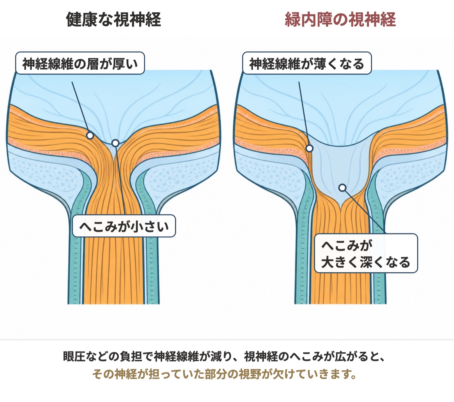 健康な視神経と緑内障の視神経の比較図。緑内障では神経線維が薄くなり、視神経のへこみが大きく深くなって、視野が欠けていきます