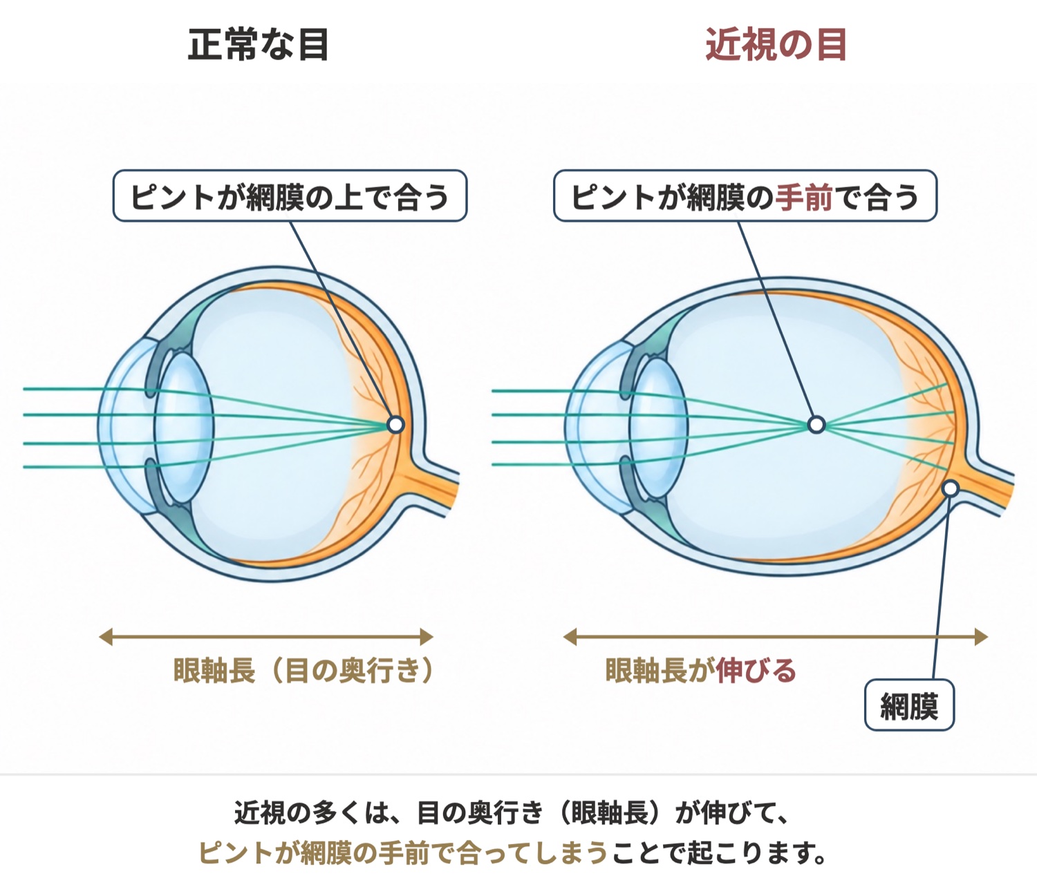 正常な目と近視の目の比較図。近視の目は奥行きが伸び、ピントが網膜の手前で合ってしまいます